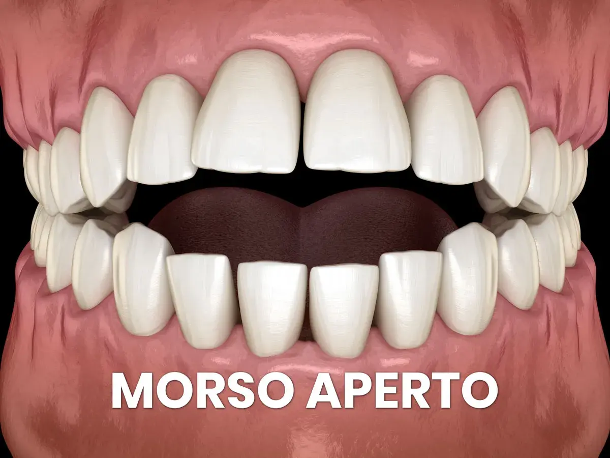 Denti bianchi e gengive rosa, con la scritta "MORSO APERTO". La lingua morsicata è visibile tra gli incisivi inferiori.