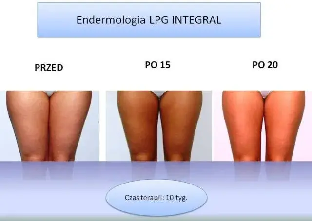 Endermologia: dla kogo? Kiedy warto, a kiedy unikać zabiegu?