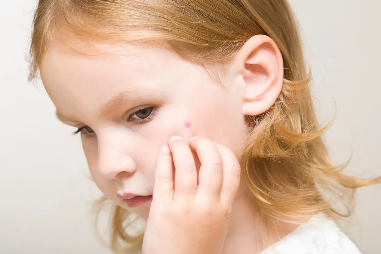 Un petit bouton rouge sur la joue d'une fillette aux cheveux blonds, peut-être un bouton de la 5ème maladie.