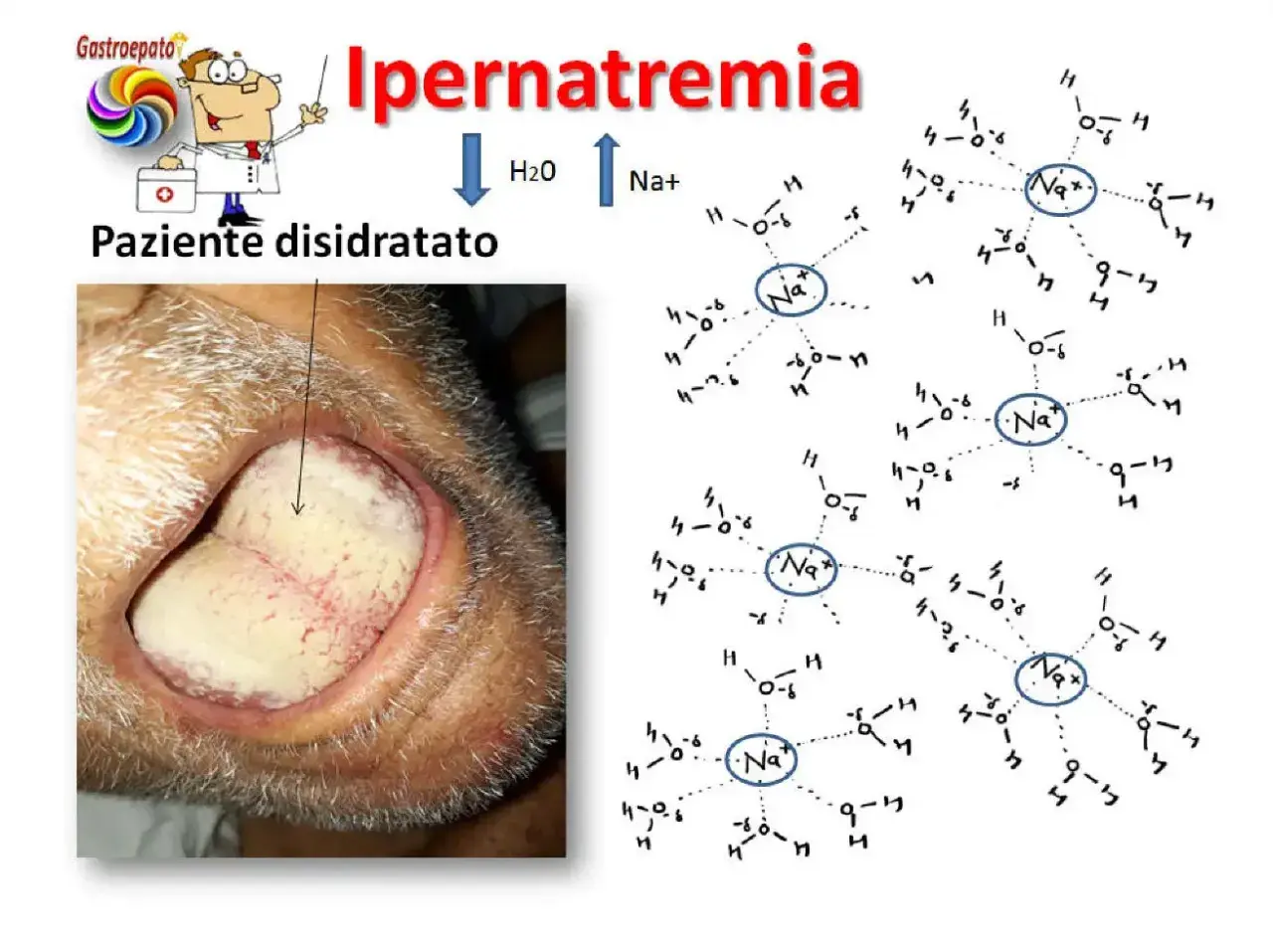 Lingua: Italiano

Ipernatremia: paziente disidratato con lingua secca e patinata, indicativo di sodio alto. Le molecole di Na+ circondate da H2O illustrano la condizione.