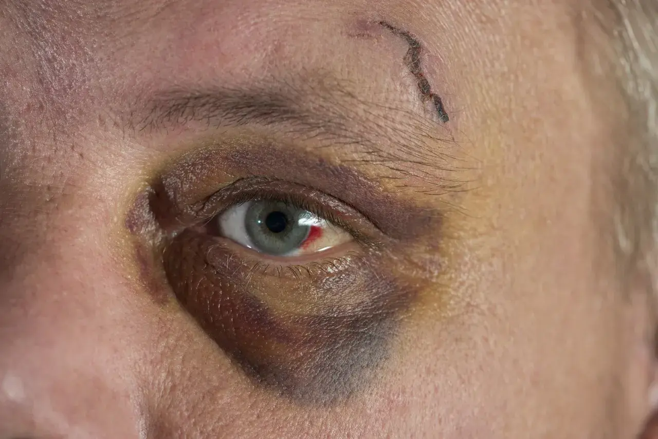 Ein blaues Auge mit einer kleinen Wunde auf der Stirn. Die Heilung dauert seine Zeit, aber das Auge wird wieder normal.