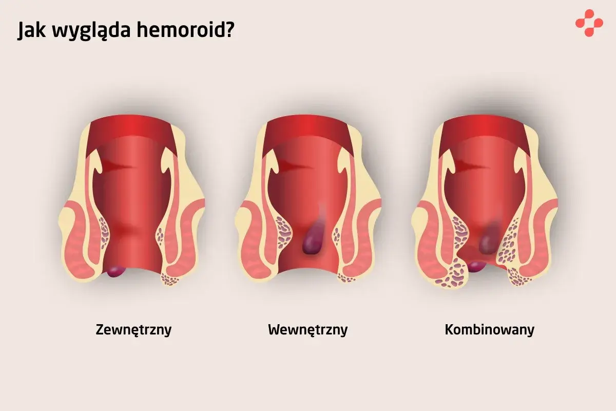Ilustracja pokazuje zewnętrzne, wewnętrzne i kombinowane hemoroidy. Wczesne objawy raka odbytu mogą być mylone z hemoroidami.