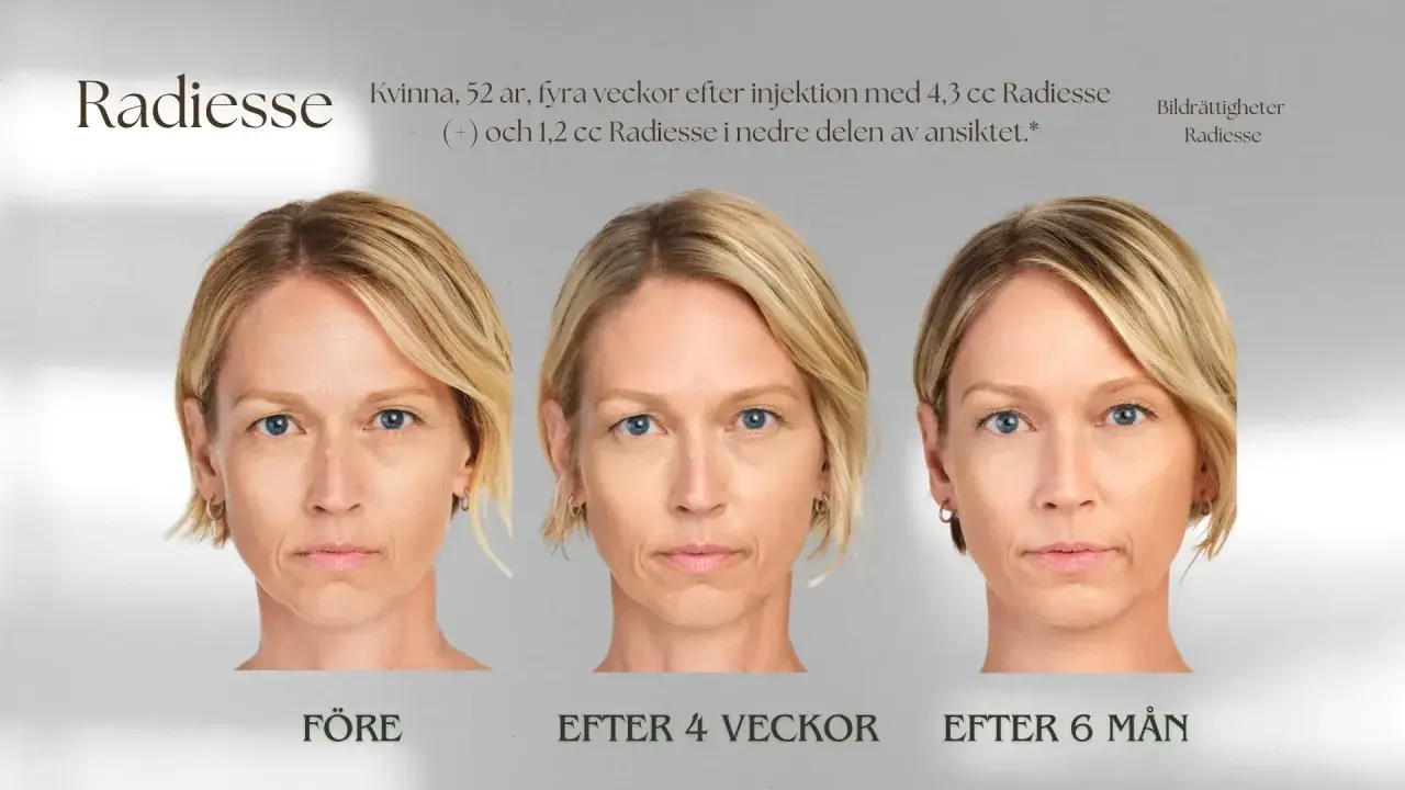 Före- och efterbilder av en 52-årig kvinna som genomgått en Radiesse behandling för att förbättra ansiktets konturer.