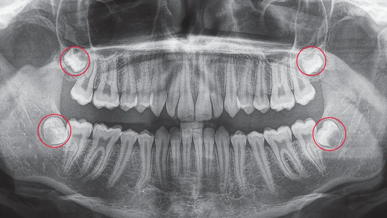 Radiografía panorámica dental. Se observan cuatro muelas del juicio impactadas, con posible hematoma tras extracción.