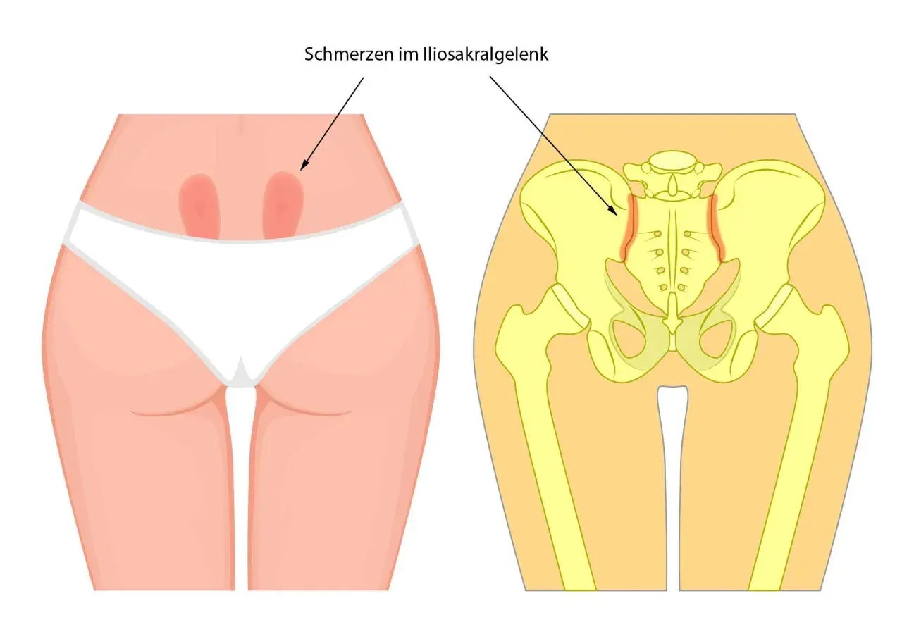 Iliosakralgelenk entzündung symptome: So erkennen Sie die Schmerzen