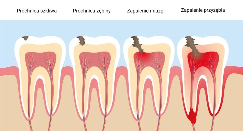 Ból zęba: czy to zapalenie miazgi? Rozpoznaj kluczowe objawy!