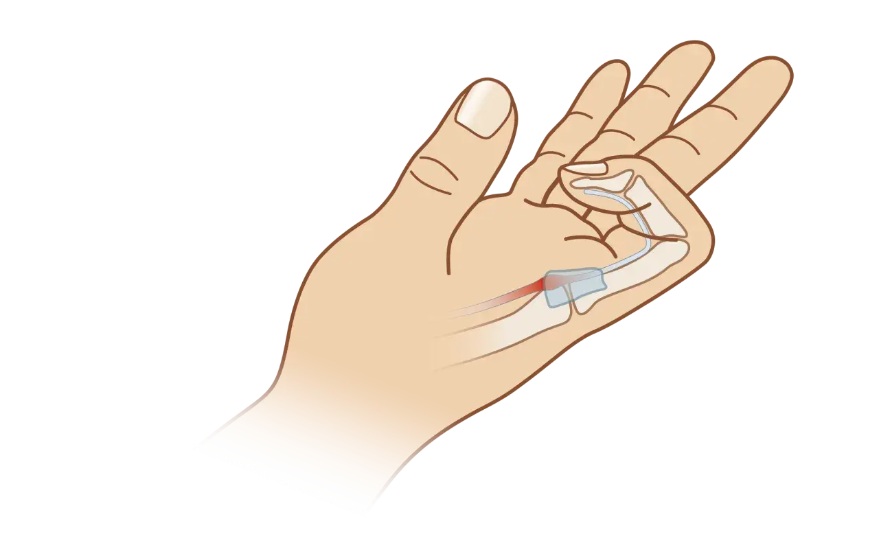 Illustration einer Hand, die zeigt, wie die Finger schmerzen beim Beugen durch eine Entzündung im Sehnenbereich.
