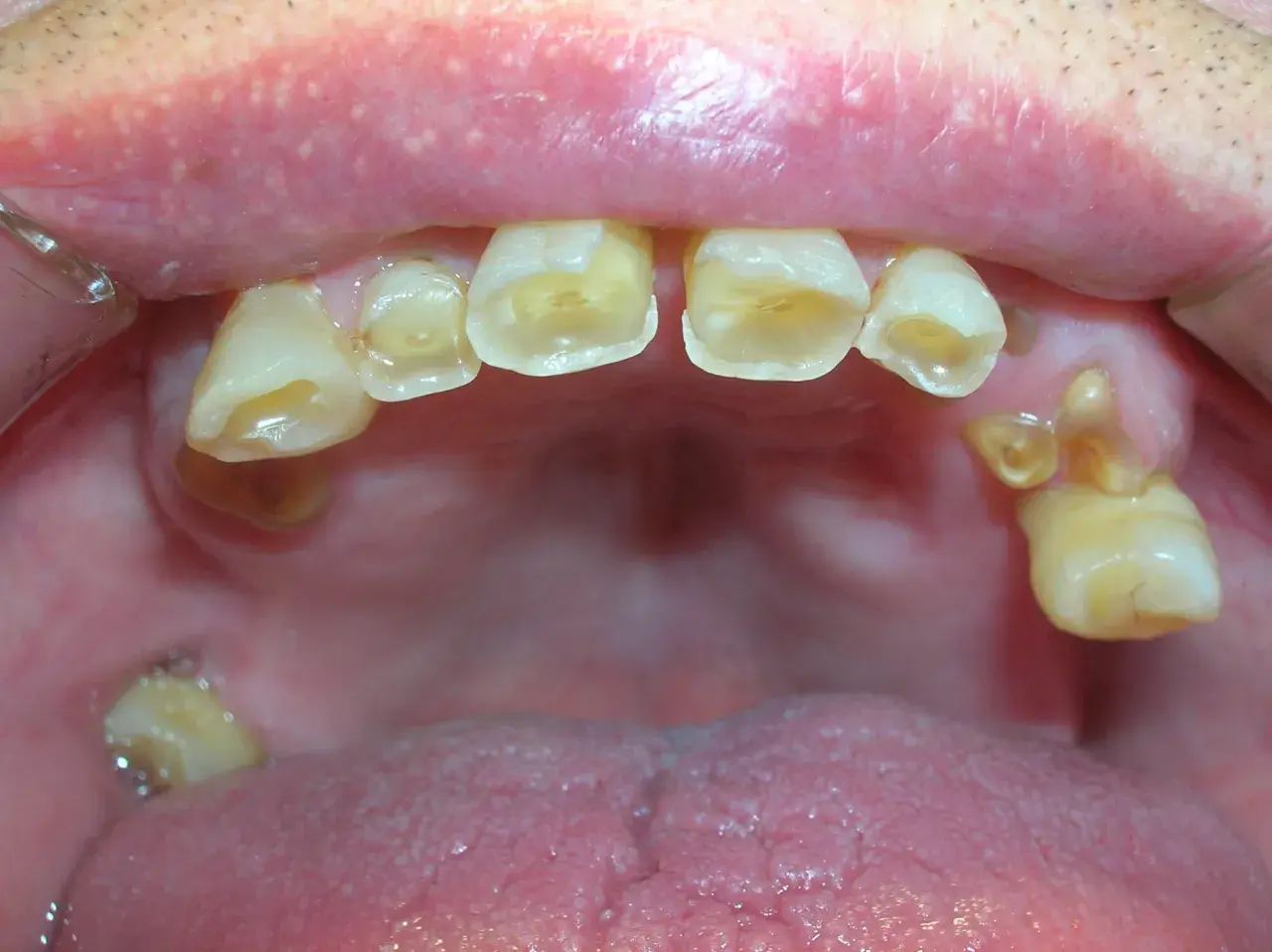 Boca con dientes desgastados y caries. Si los de abajo se mueven, los de arriba se caen.