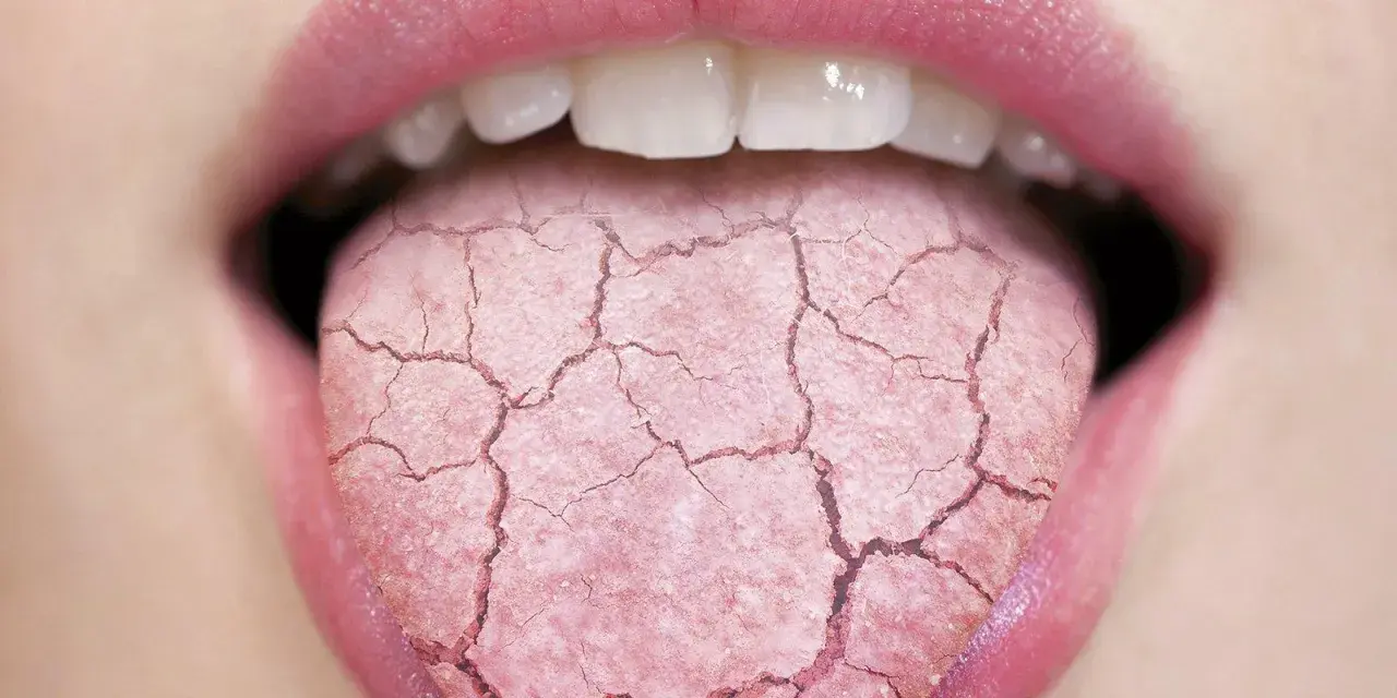 Lengua agrietada y seca, indicando posible boca ardorosa. Busca un tratamiento natural para aliviar la sequedad.