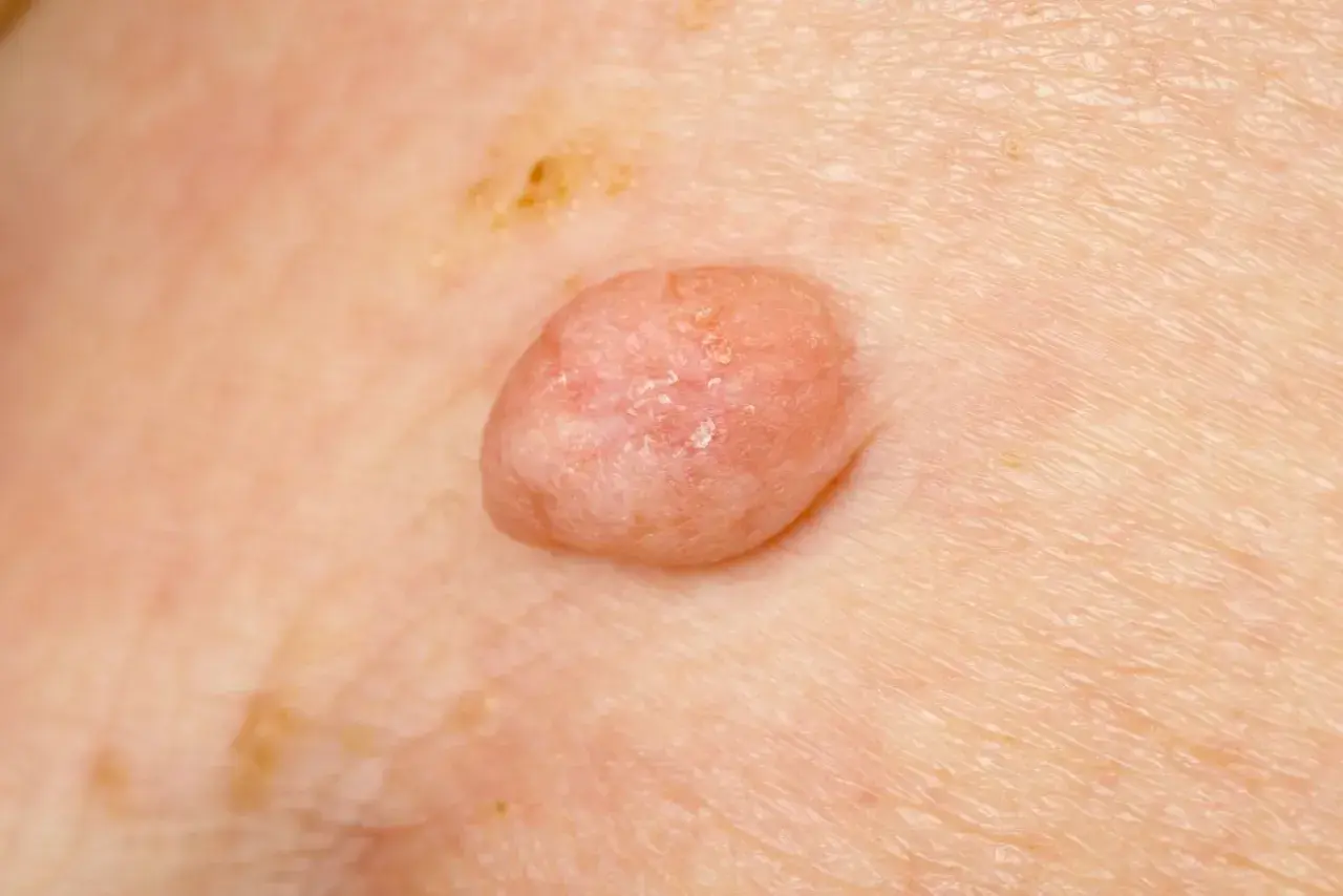 Zmiana skórna, która może być jednym z objawów HPV. Widoczny różowy, brodawkowaty narośl na skórze.