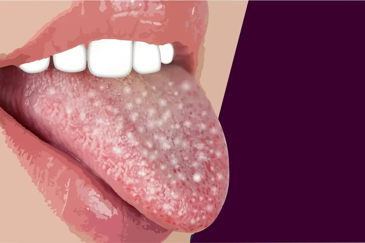 Lingua con puntini bianchi visibili, che potrebbero indicare una condizione medica.