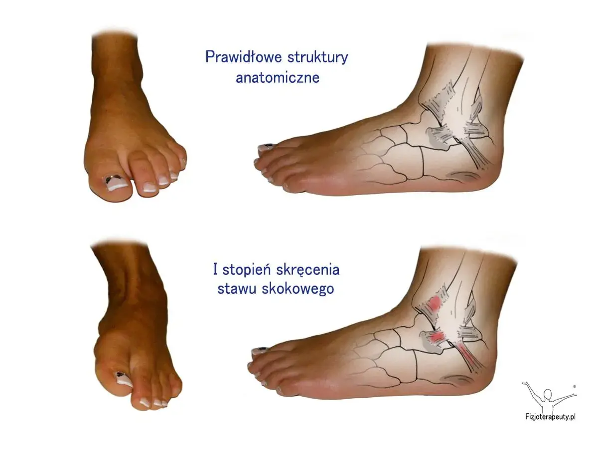 Po tym, jak krzywo stanąłem i boli mnie kostka, porównuję prawidłowe struktury anatomiczne stawu skokowego z I stopniem skręcenia.