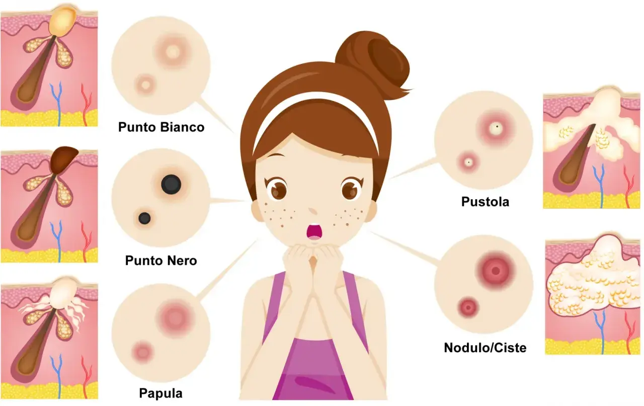 Ragazza preoccupata per i brufoli: punto bianco, punto nero, papula, pustola e nodulo/cisti illustrati.