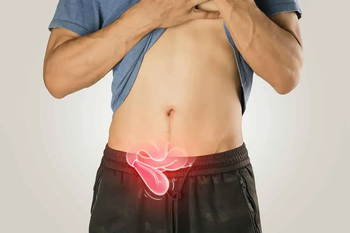 Hombre con un bulto en la ingle, representado con un área roja brillante en la zona abdominal inferior.