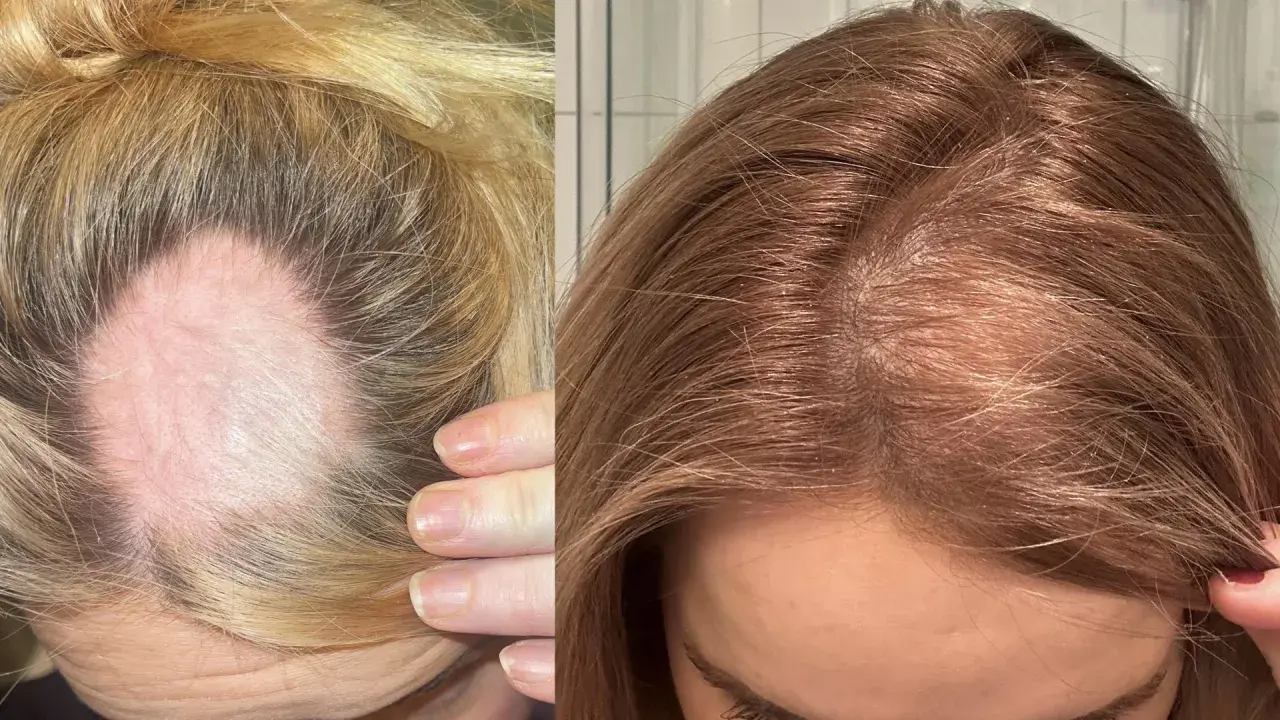 Före- och efterbilder som visar förbättring av androgent håravfall. Till vänster syns en kal fläck på en ljusblond hårbotten, till höger tätare, mörkare hår.
