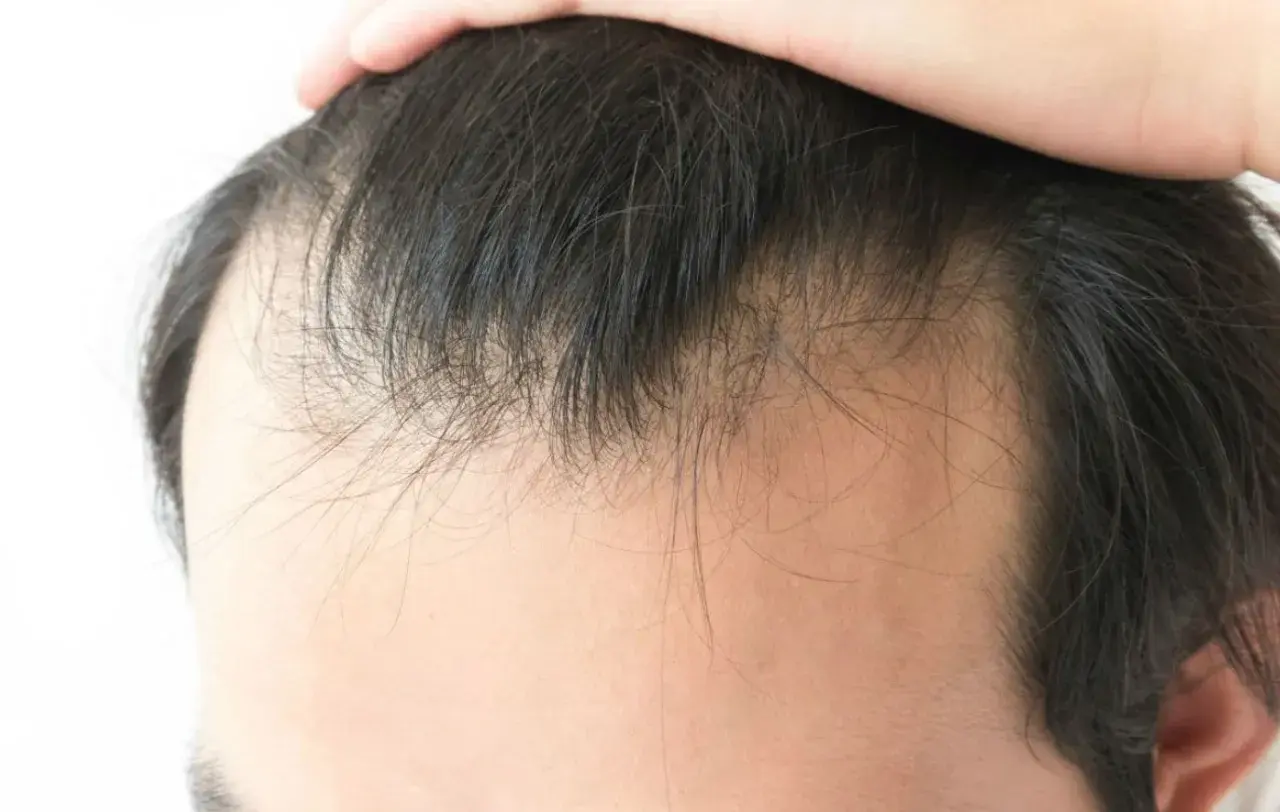 Primer plano de la línea del cabello de un hombre, mostrando adelgazamiento y entradas. Una mano toca la parte superior de la cabeza, quizás preguntándose porque los hombres se quedan calvos.