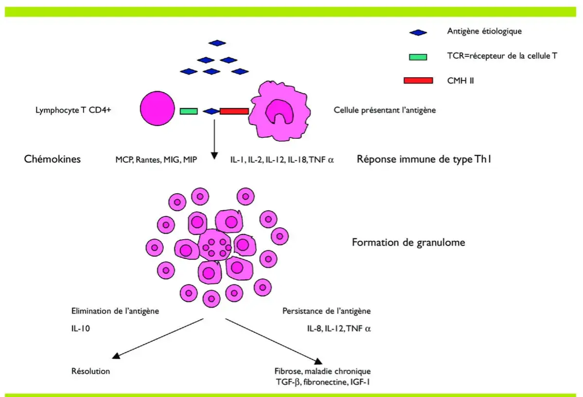 Schéma illustrant la formation de granulomes, un symptôme de la sarcoïdose, impliquant des lymphocytes T et des cellules présentant l'antigène.
