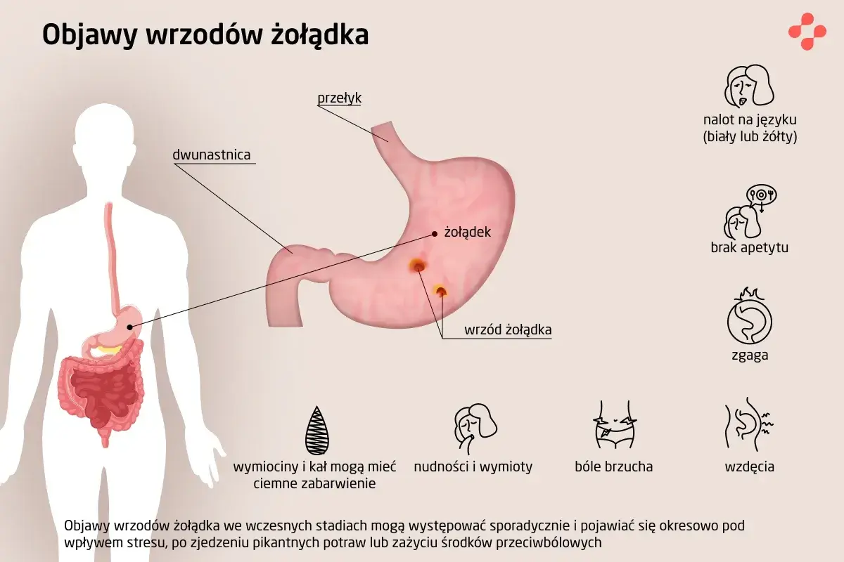 Ilustracja przedstawia objawy wrzodów żołądka: nalot na języku, brak apetytu, zgaga, bóle brzucha, wzdęcia, wymioty.