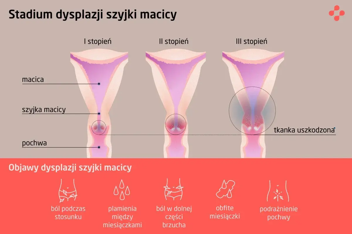 Grafika pokazuje stadia dysplazji szyjki macicy: I, II i III stopień, z zaznaczonymi objawami jak ból, plamienia i podrażnienie.