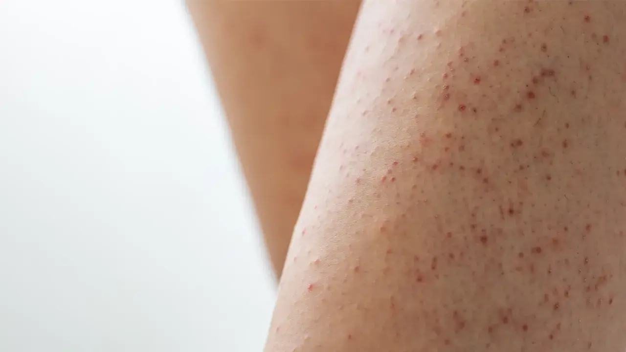 Närbild på ben med keratosis pilaris, små röda prickar som ger en knottrig hudtextur.
