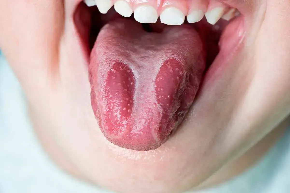 Lengua geográfica con parches blancos y rosados, como un mapa de sabores.