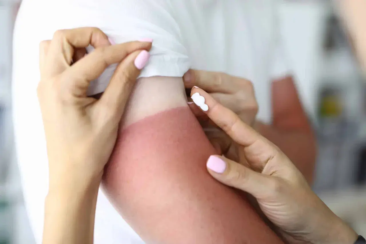 Application de crème pour désinfecter une brûlure solaire sur un bras rouge.