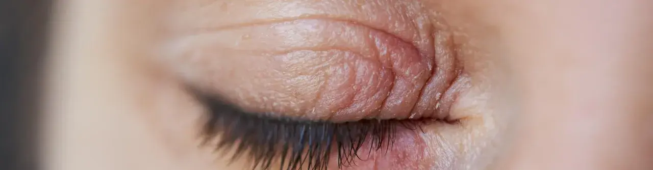 Gros plan sur un œil fermé, montrant la peau ridée et sèche de la paupière, signe d'une irritation paupière.