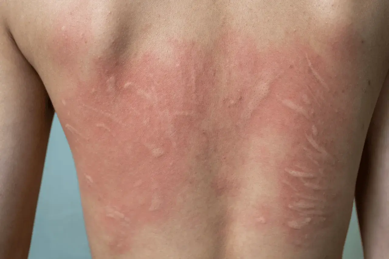Schiena di un bambino con eritema e pomfi, segni tipici di orticaria. Come riconoscerla nei più piccoli.