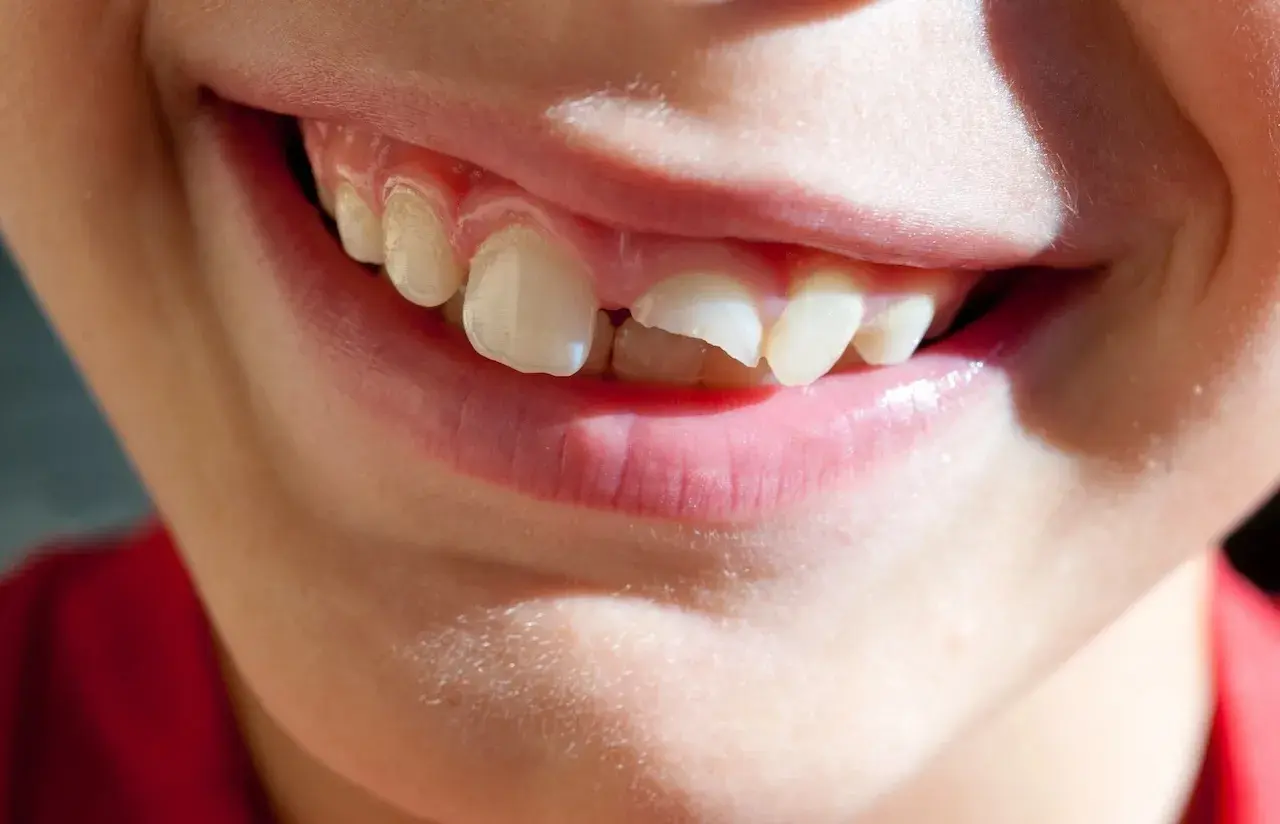 Sorriso di bambino con un dente spezzato, un piccolo incidente che non ferma la gioia.