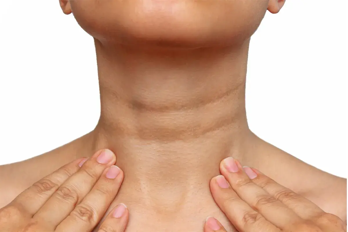 Cuello con acantosis nigricans, mostrando la hiperpigmentación y textura irregular. Se exploran opciones de tratamiento.