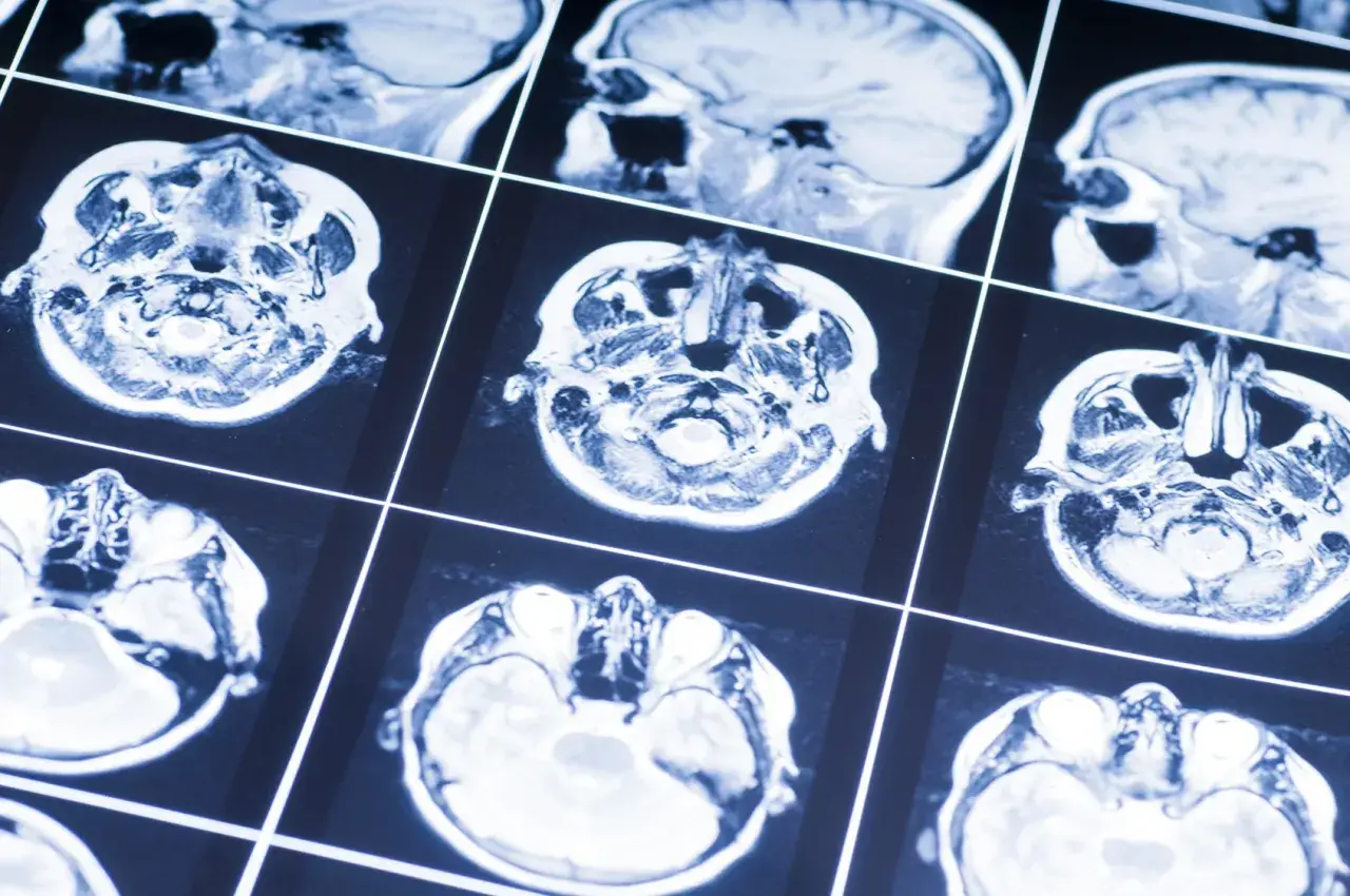 Przekroje mózgu na rezonansie magnetycznym. Obraz może pomóc w diagnostyce oponiak objawy, analizując strukturę tkanki mózgowej.
