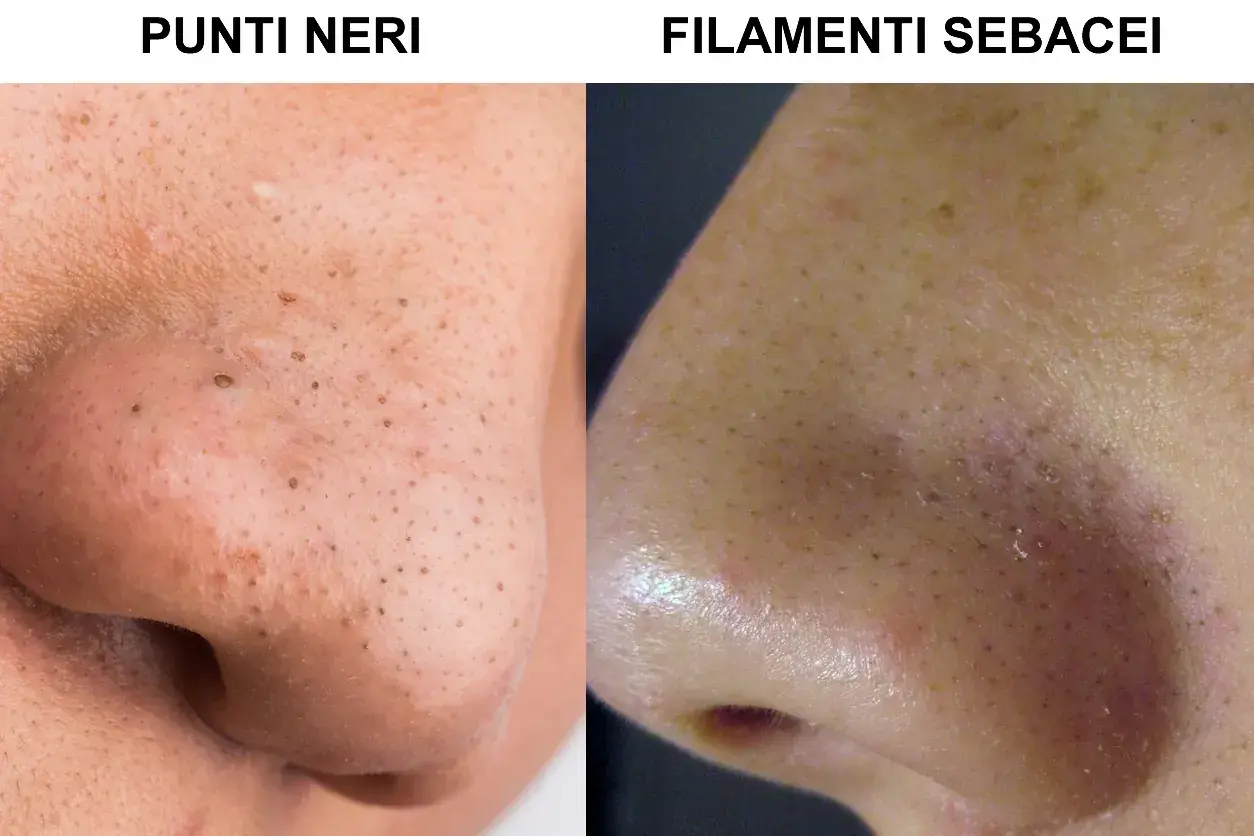 Confronto tra punti neri e filamenti sebacei sul naso. Scopri come togliere i punti neri per una pelle più liscia.