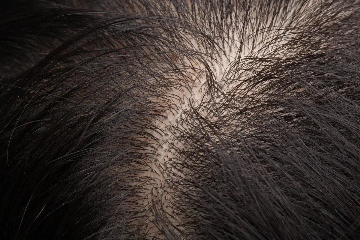Primo piano del cuoio capelluto con capelli scuri e radi, che sembrano ruvidi al tatto.