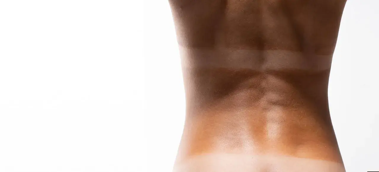 Dos bandes de bronzage distinctes sur le dos, témoignant d'une exposition au soleil ou aux rayons uv b.