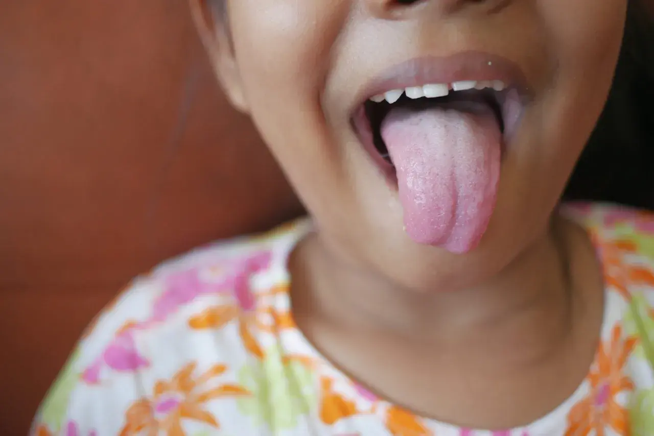 Niña saca la lengua, mostrando una capa blanca. Podría necesitar remedios caseros para la lengua blanca.