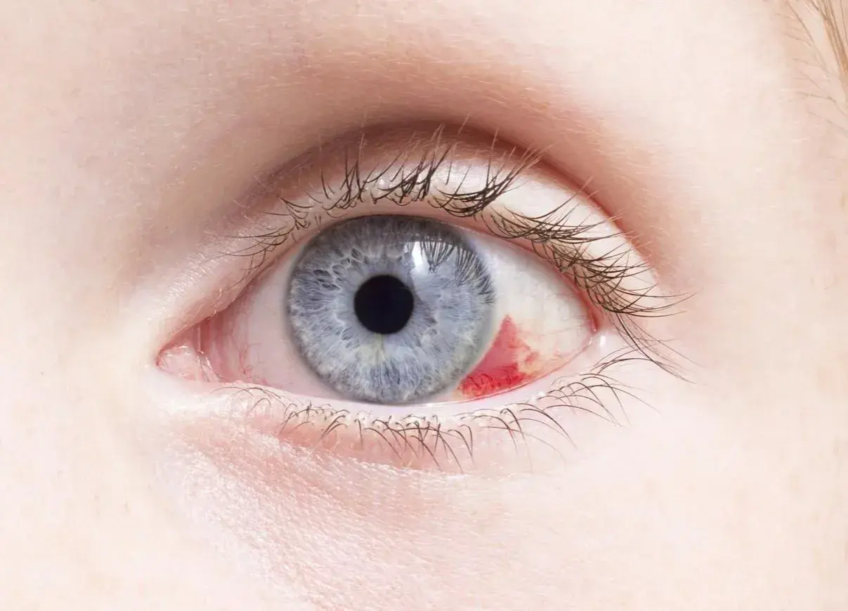 Ojo azul con hemorragia subconjuntival. Parece un bebé con ojos rojos por fuera, pero es un adulto.