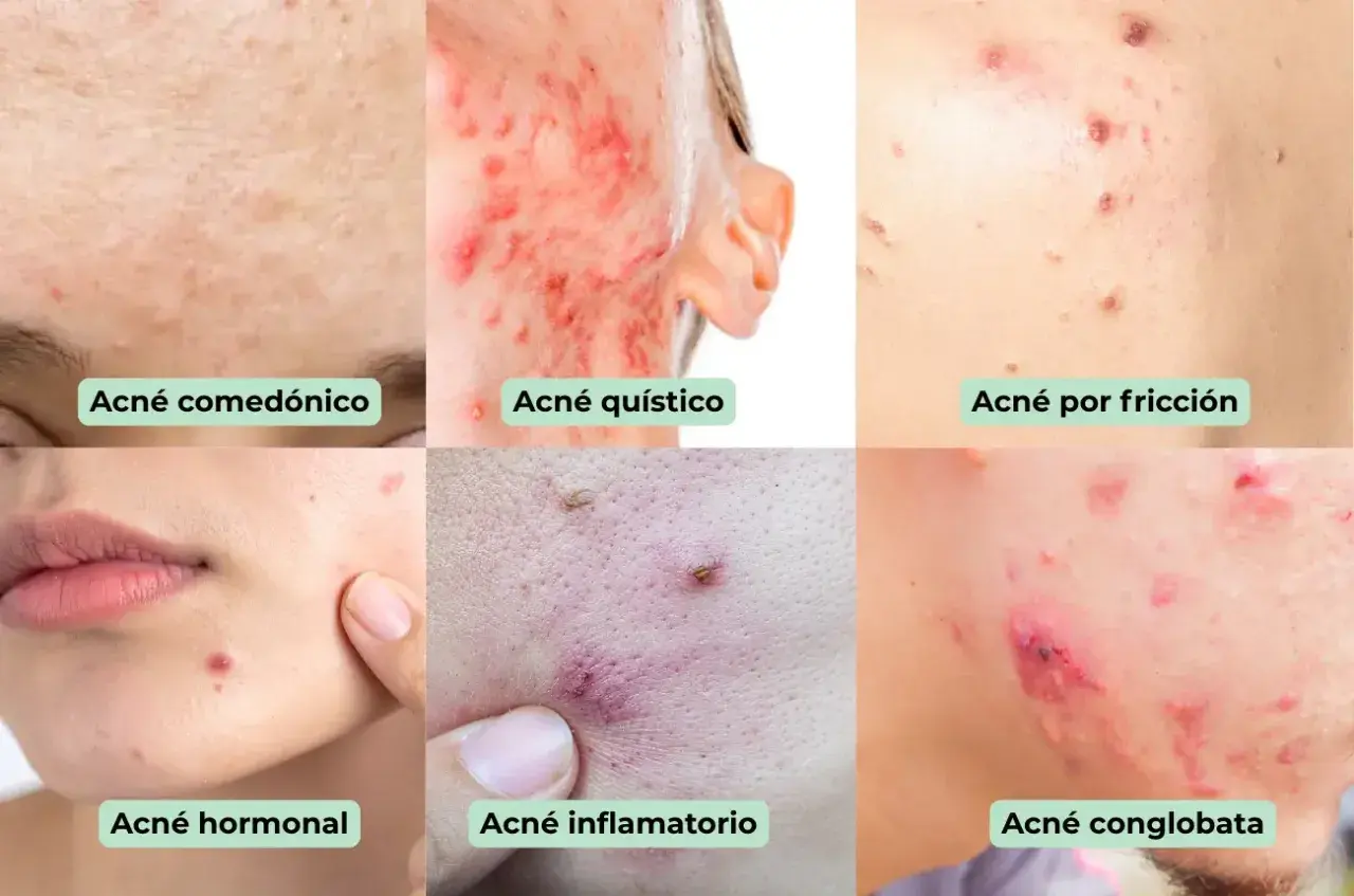 Seis tipos de granos en la cara: comedónico, quístico, por fricción, hormonal, inflamatorio y   conglobata.
