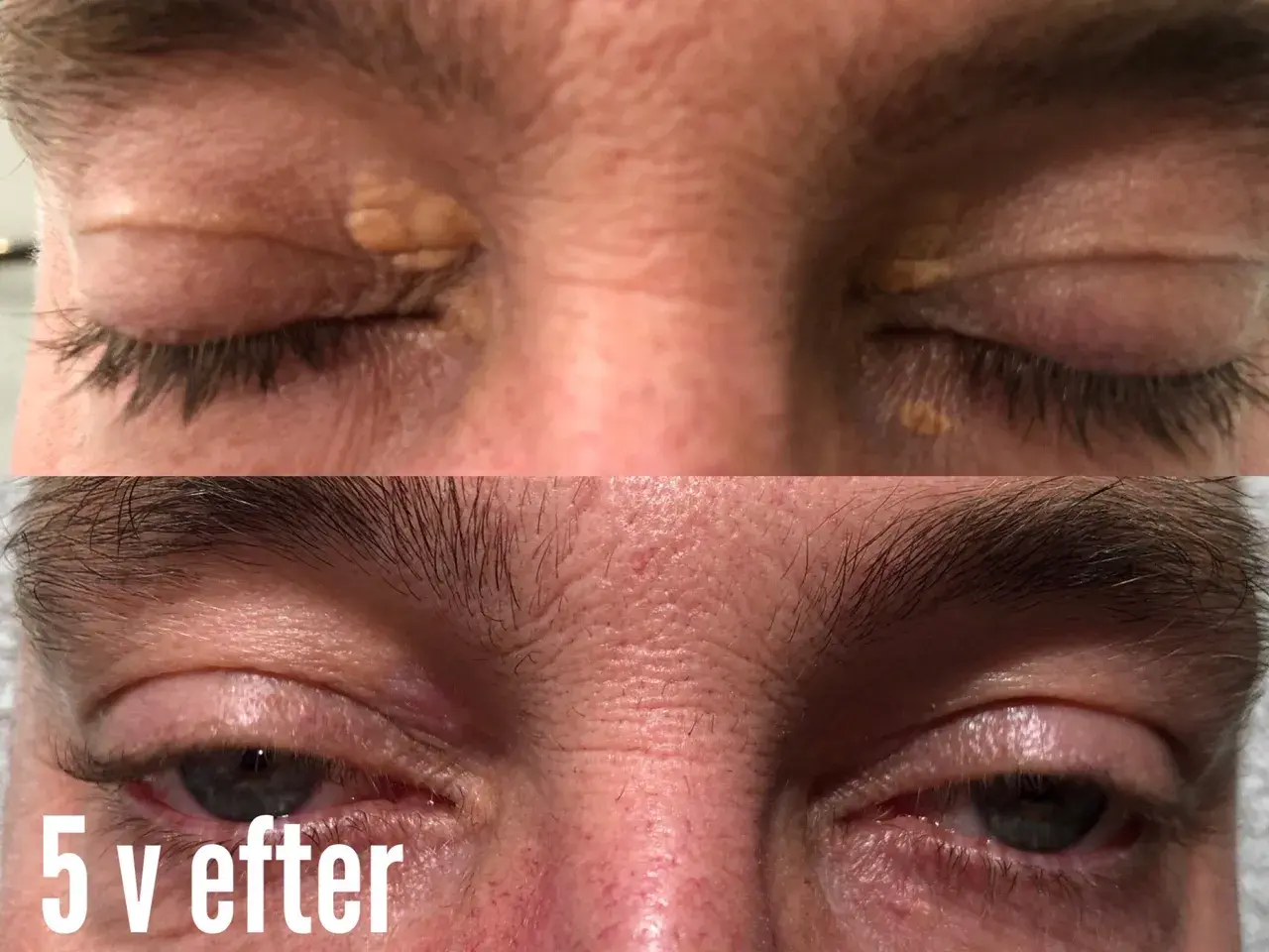 Före- och efterbilder som visar hur xantelasma har behandlats.