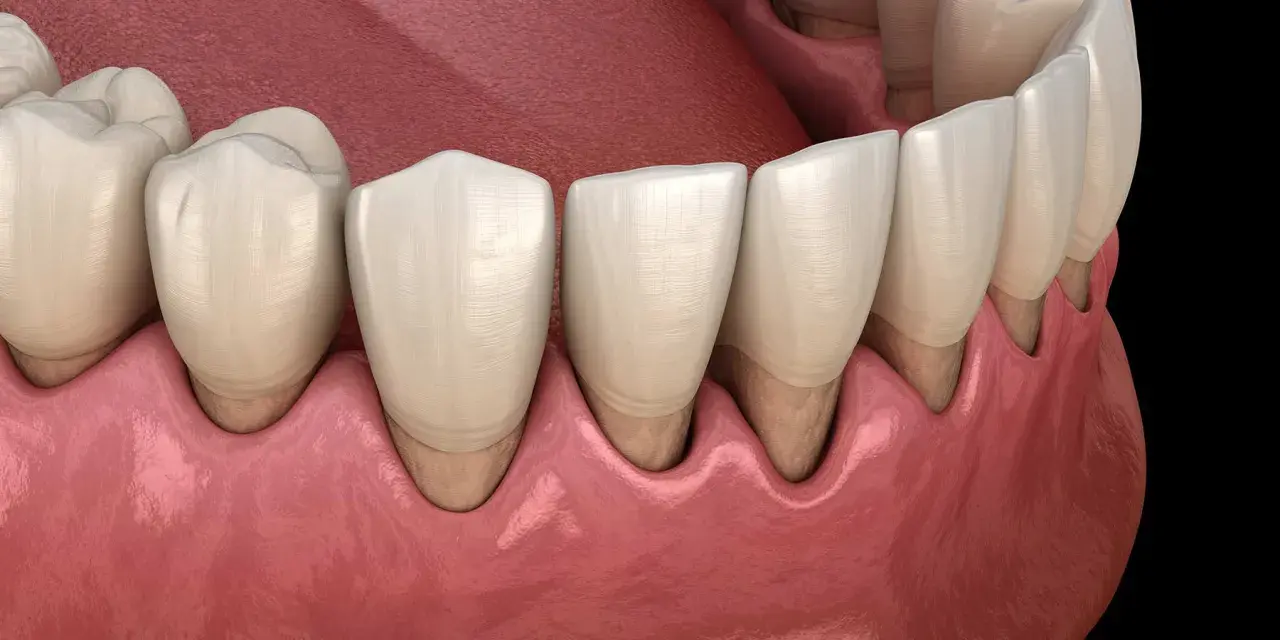 Dientes sanos y encías rosadas. Ilustración que muestra cómo tratar periodontitis para recuperar la salud bucal.