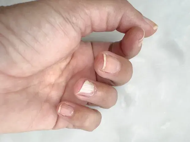Odrastanie paznokcia: Ile trwa i jak przyspieszyć?