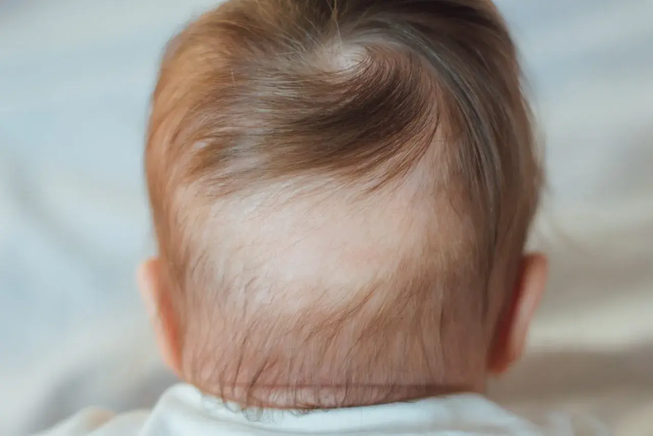 Dettaglio della nuca di un neonato con capelli castani e una chiazza di piebaldismo, dove i capelli sono più chiari.