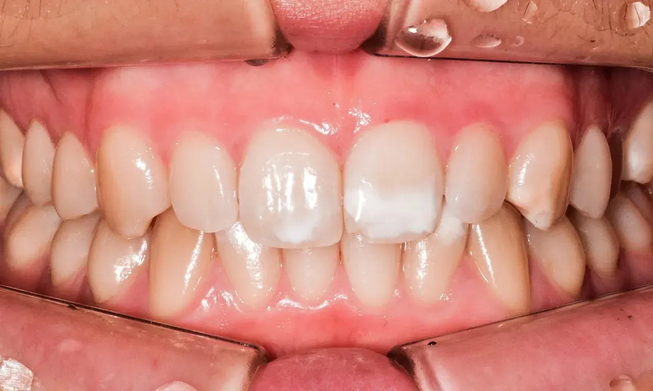 Denti con macchie bianche, possibili segni di carie iniziale.