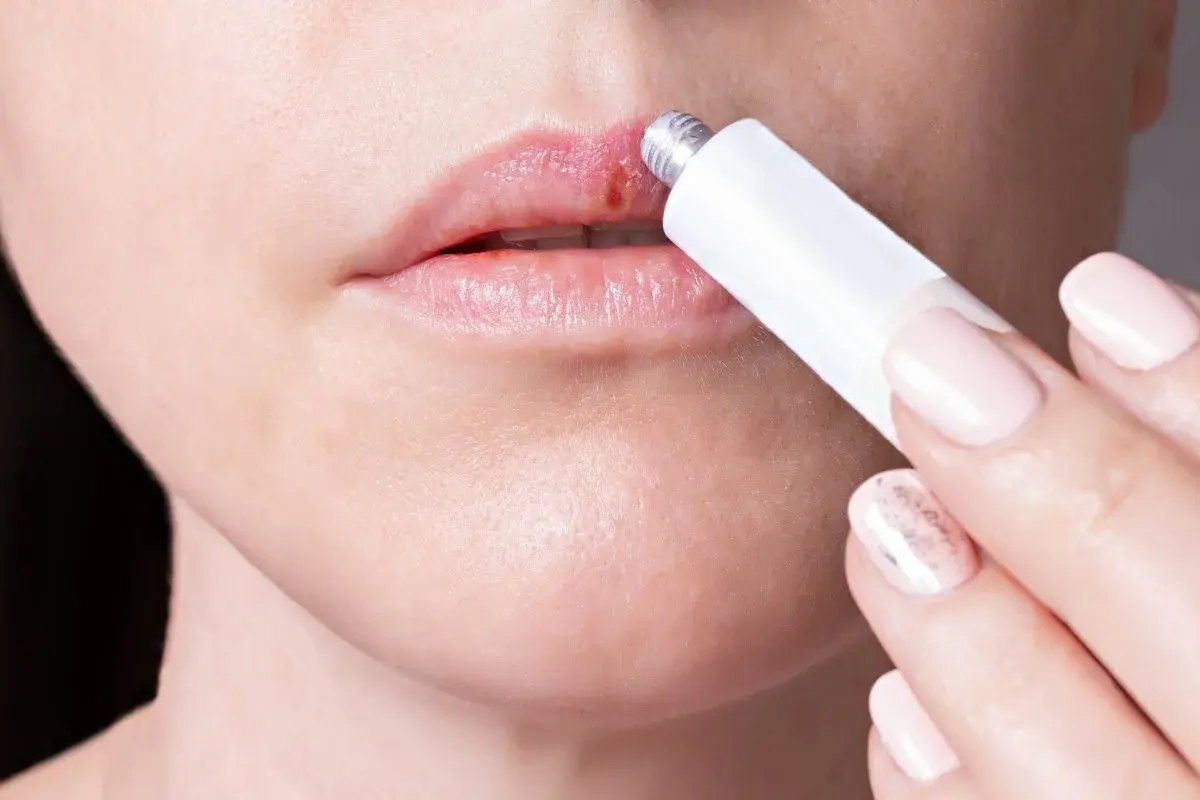 Persona aplica crema en un labio con un afta labial.