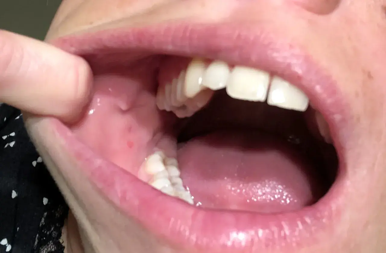 Dettaglio della bocca con afte sulla guancia interna. Si notano piccole lesioni rosse e gonfiore.
