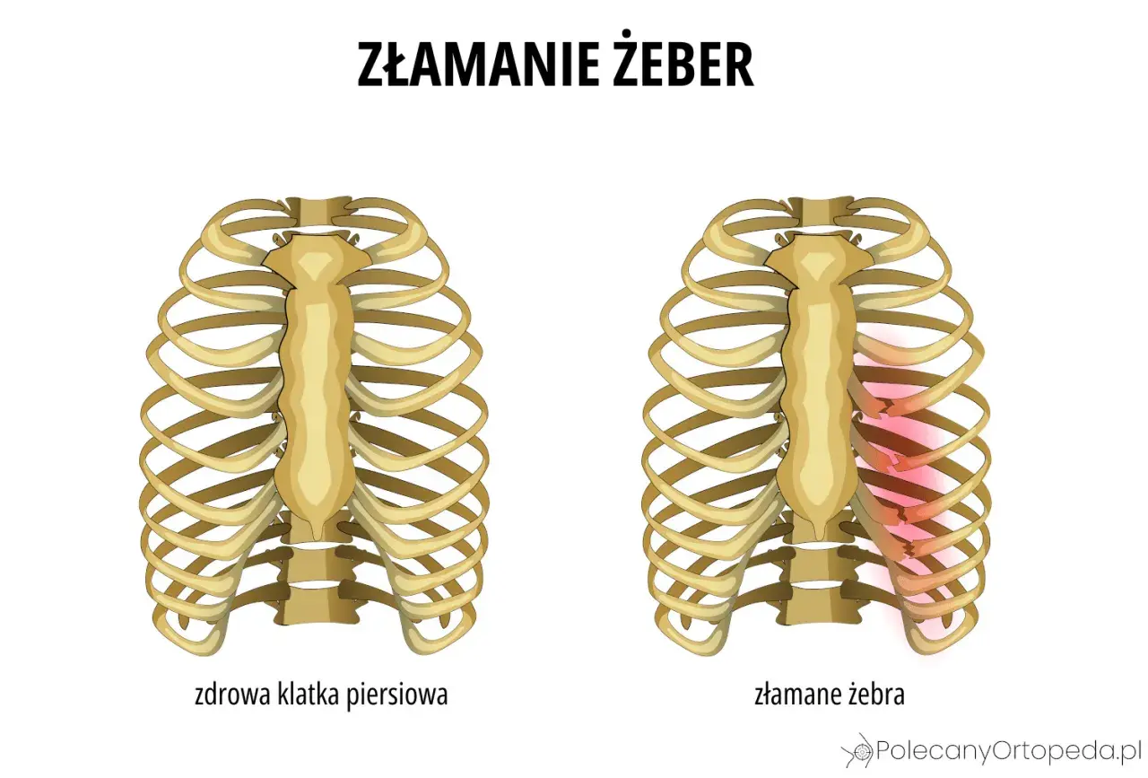 Porównanie zdrowej klatki piersiowej z tą, gdzie widoczne są stłuczone żebra bez siniaka, zaznaczone czerwonym rumieńcem.