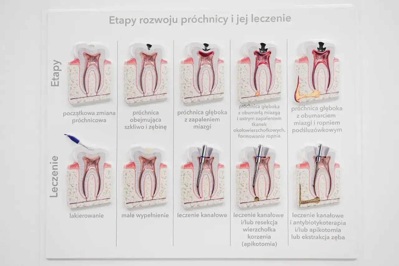 Grafika pokazuje etapy rozwoju próchnicy i jej leczenia, od początkowej zmiany do ropnia zęba, a następnie metody leczenia, w tym leczenie kanałowe.