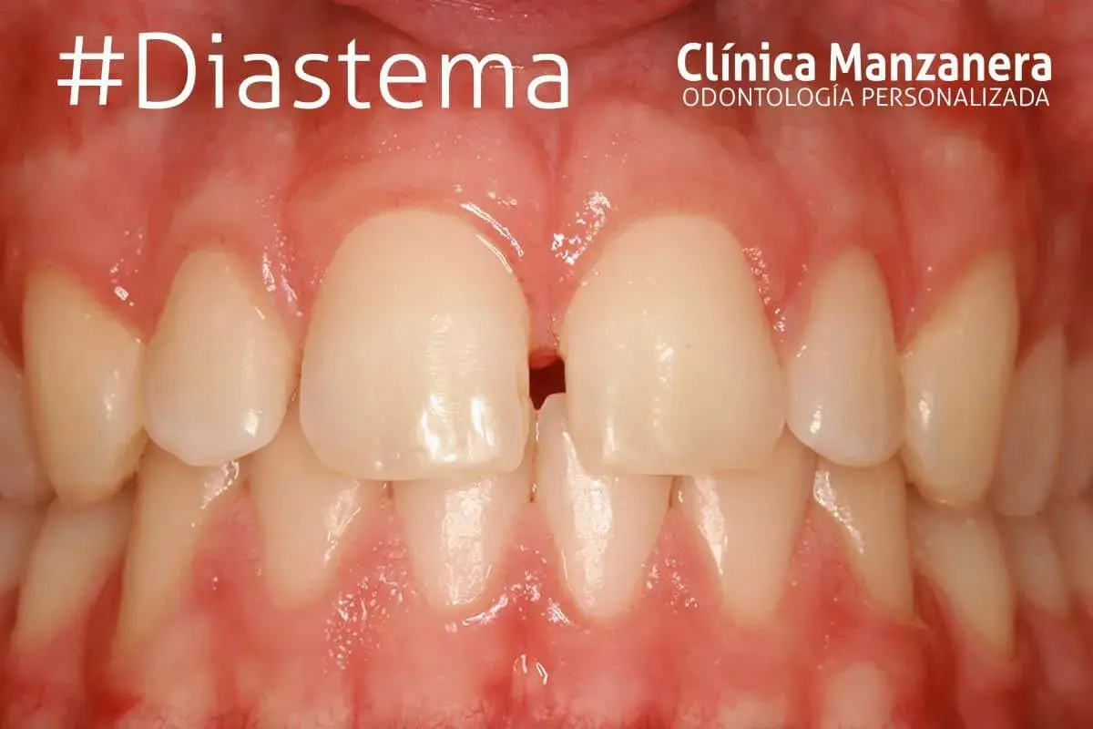 Primeros planos de dientes con un espacio visible entre los incisivos centrales superiores, un ejemplo de brackets dientes separados.