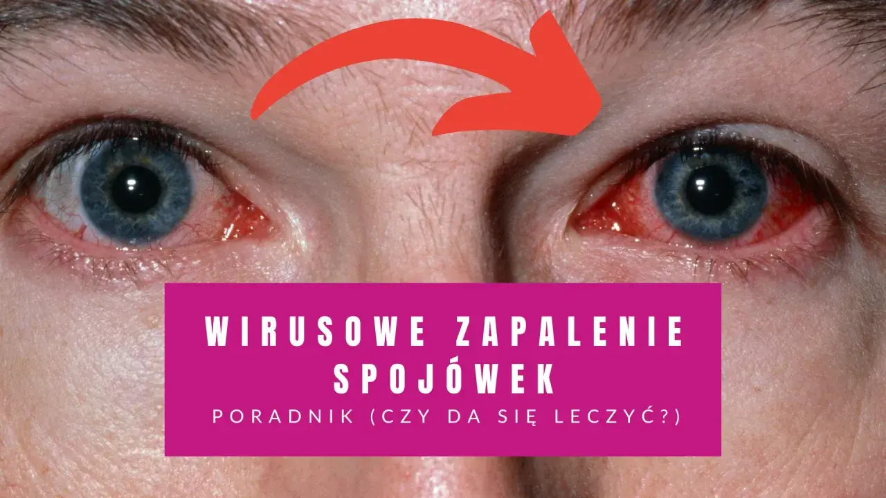 Czerwone, podrażnione oczy z widocznymi naczynkami. Napis: "Wirusowe zapalenie spojówek - poradnik".