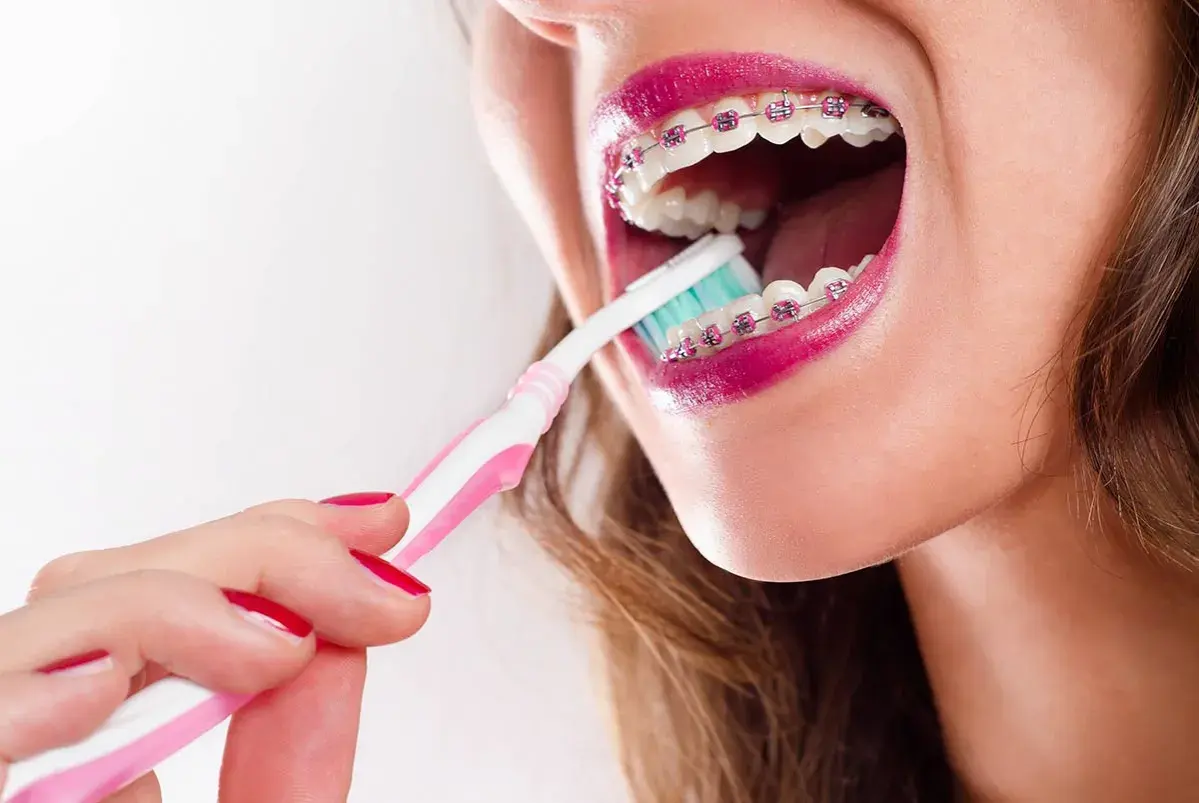 Mujer cepillando sus brackets transparentes con un cepillo rosa y blanco.