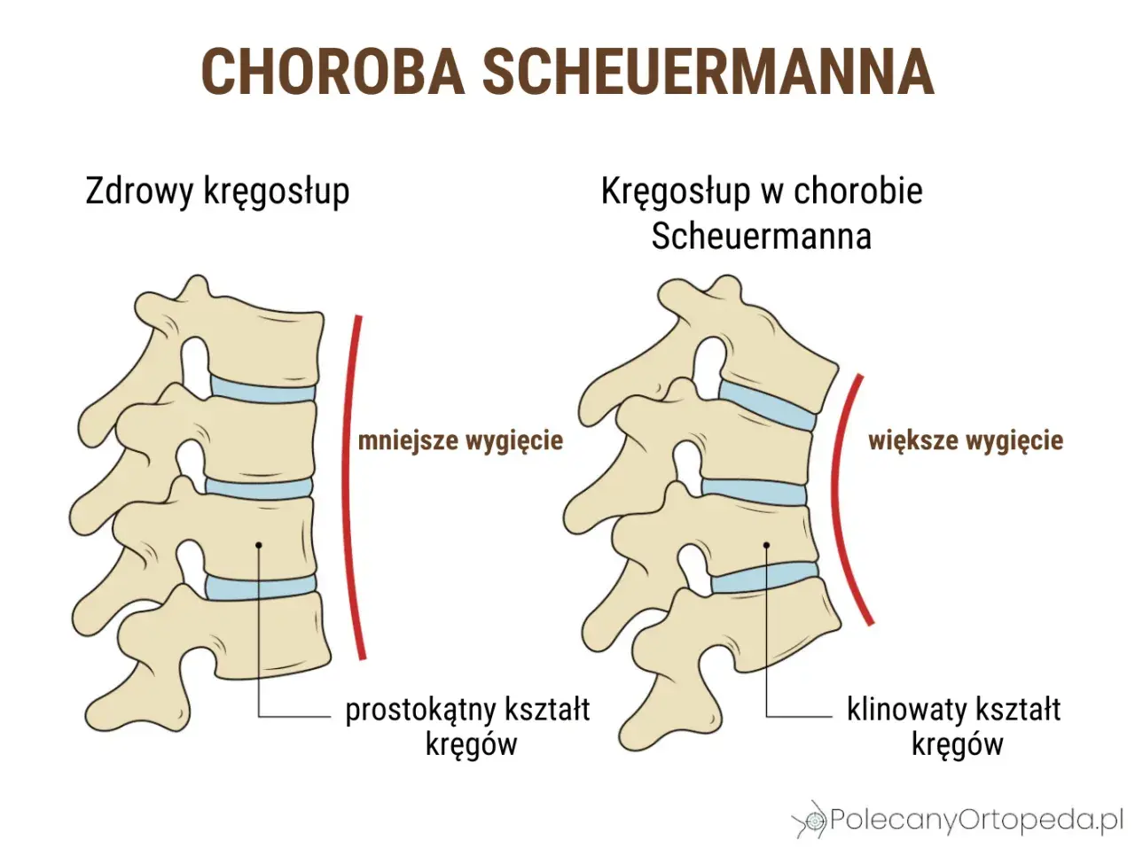 Porównanie kręgosłupa zdrowego i w chorobie Scheuermanna u dorosłych. Widoczne klinowate kręgi i większe wygięcie kręgosłupa.